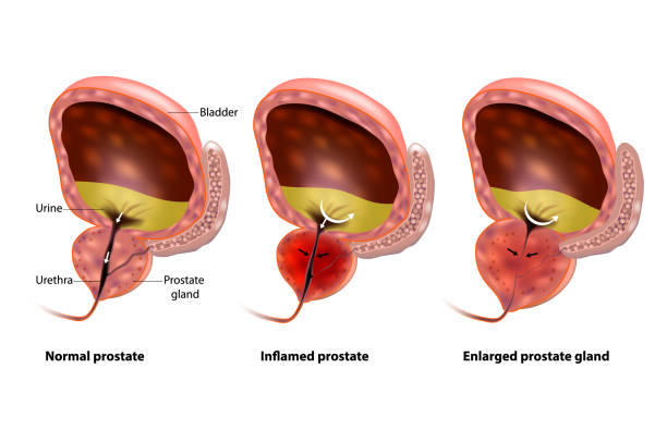 prostate inflammation